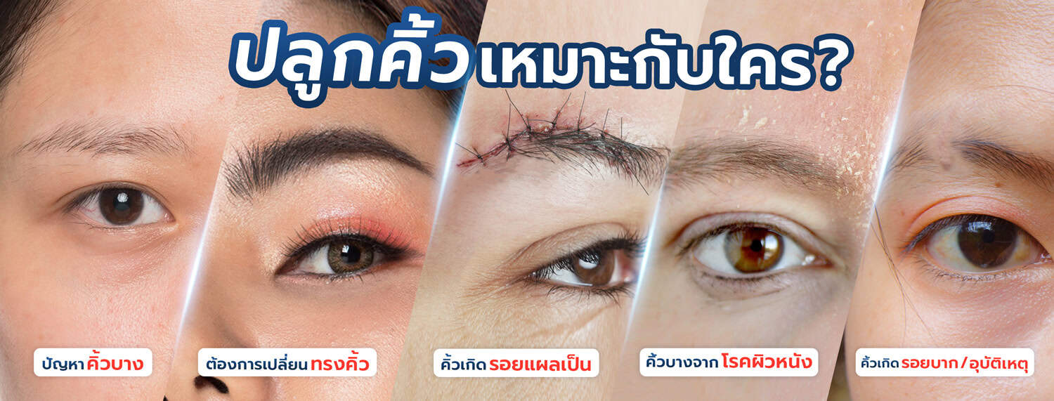 Eyebrow transplant เหมาะกับใคร