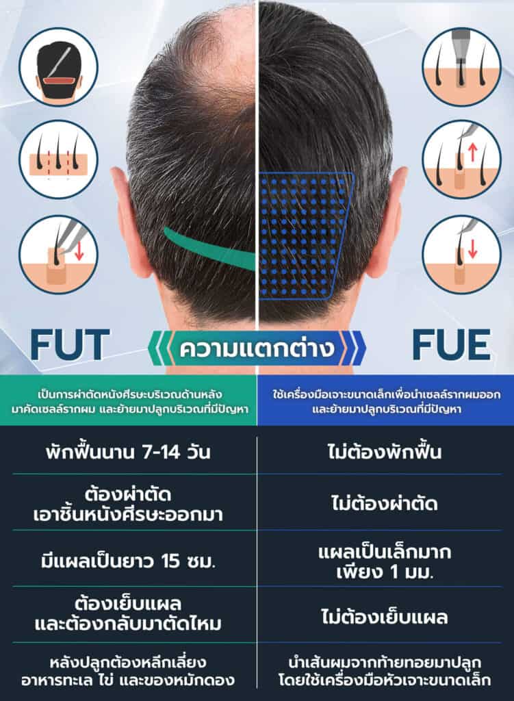 ความแตกต่างระหว่าง FUT และ FUE