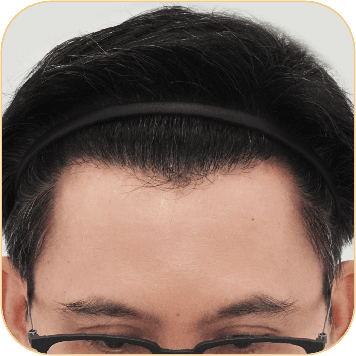 ปลูกผมเทคนิค VDHi Non Shaven FUE ไม่โกนผม โดยหมอพลอย -1