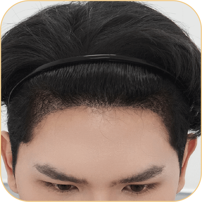 ปลูกผมเทคนิค VDHi Non Shaven FUE ไม่โกนผม โดยหมอพลอย - 3