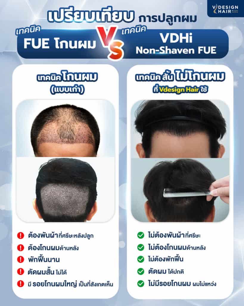 เปรียบเทียบการปลูกผม VDHi Non Shaven FUE กับ Shaven FUE